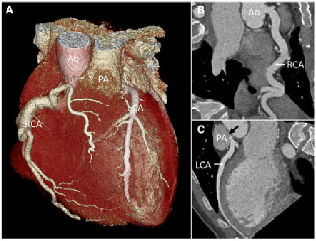 CT Coronary Angiography