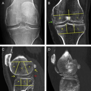 ct knee joint